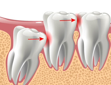 picture of an impacted tooth